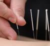 Ce este acupunctura?
